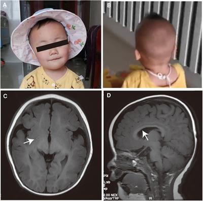 Identification of a novel METTL23 gene variant in a patient with an intellectual development disorder: a literature review and case report